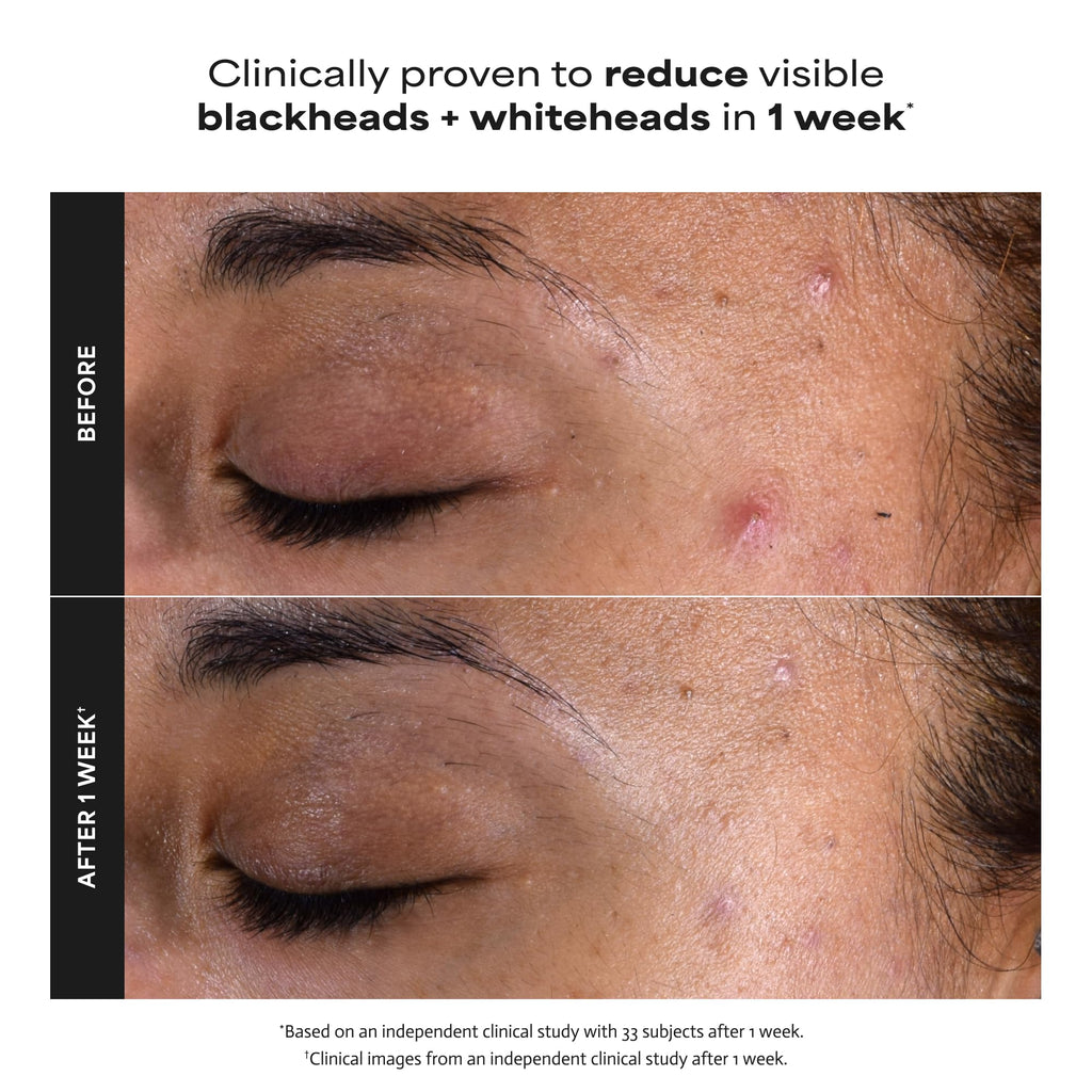 Paula's Choice SKIN PERFECTING 2% BHA Liquid Exfoliant with Salicylic Acid, Facial Polish for Pores, Wrinkles & Fine Lines, Suitable for Blackhead-Prone Skin, Fragrance-Free